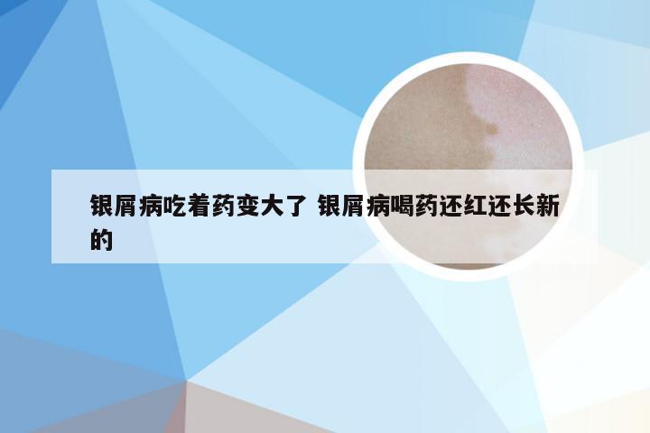 银屑病吃着药变大了 银屑病喝药还红还长新的