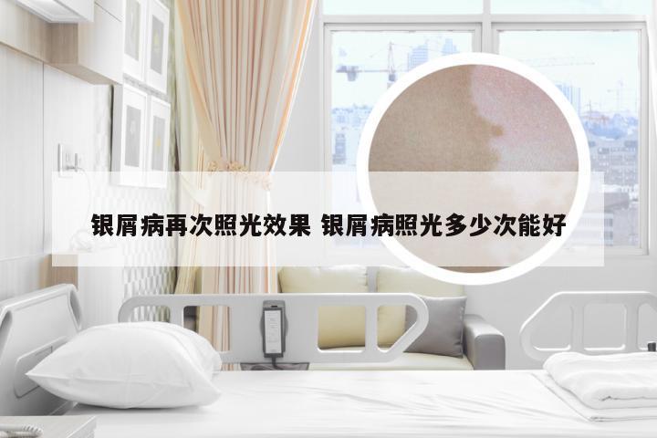 银屑病再次照光效果 银屑病照光多少次能好