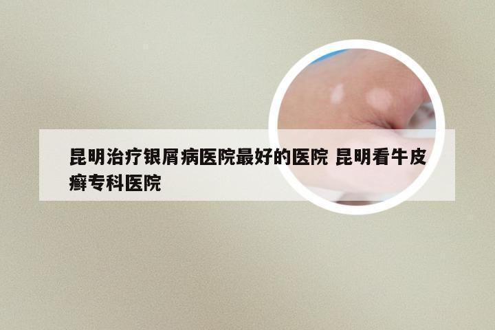 昆明治疗银屑病医院最好的医院 昆明看牛皮癣专科医院