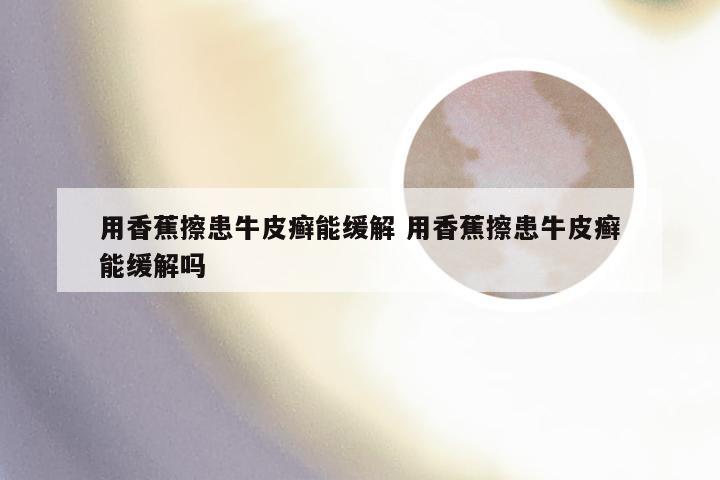 用香蕉擦患牛皮癣能缓解 用香蕉擦患牛皮癣能缓解吗