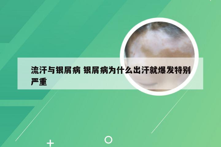 流汗与银屑病 银屑病为什么出汗就爆发特别严重