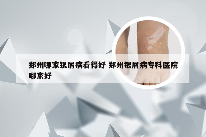 郑州哪家银屑病看得好 郑州银屑病专科医院哪家好