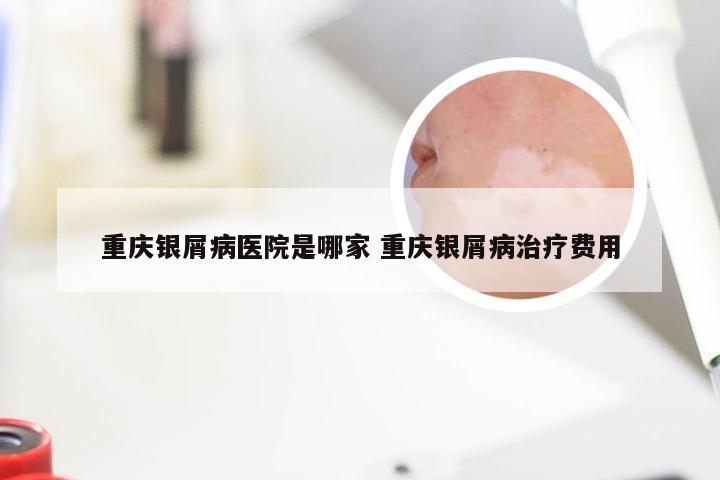 重庆银屑病医院是哪家 重庆银屑病治疗费用