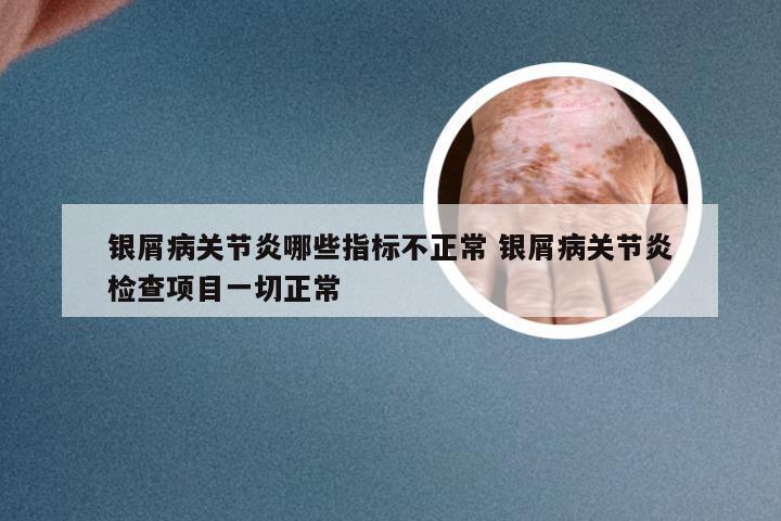 银屑病关节炎哪些指标不正常 银屑病关节炎检查项目一切正常
