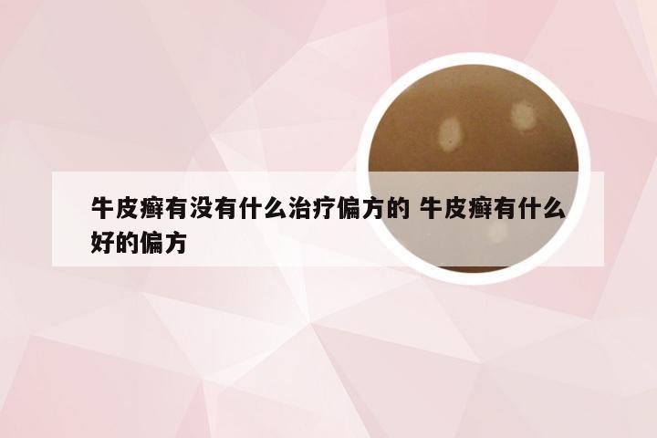 牛皮癣有没有什么治疗偏方的 牛皮癣有什么好的偏方