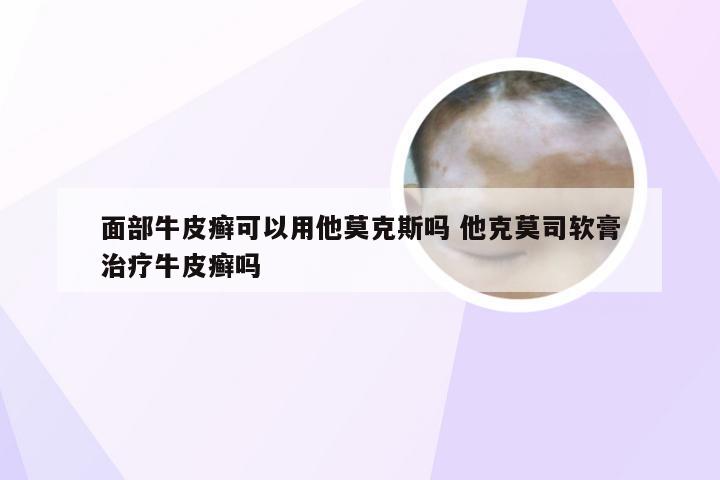 面部牛皮癣可以用他莫克斯吗 他克莫司软膏治疗牛皮癣吗