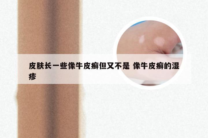 皮肤长一些像牛皮癣但又不是 像牛皮癣的湿疹