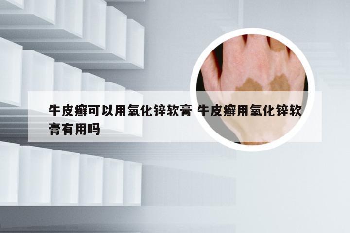 牛皮癣可以用氧化锌软膏 牛皮癣用氧化锌软膏有用吗