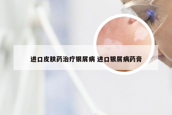 进口皮肤药治疗银屑病 进口银屑病药膏
