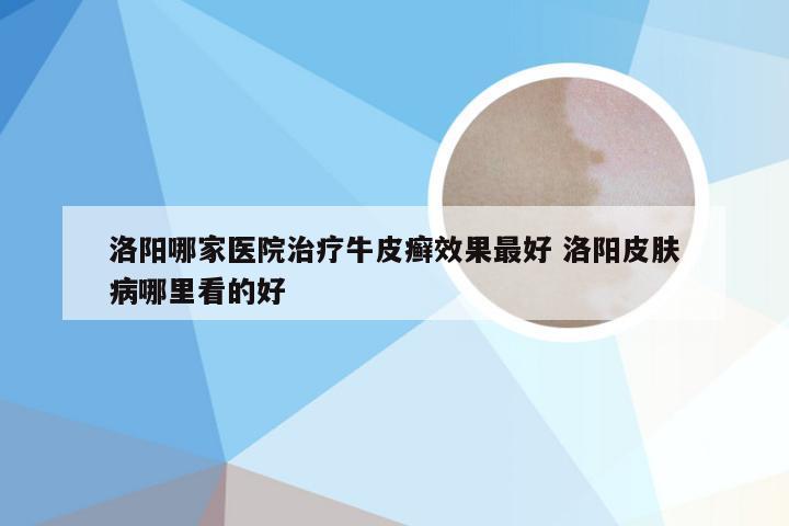 洛阳哪家医院治疗牛皮癣效果最好 洛阳皮肤病哪里看的好