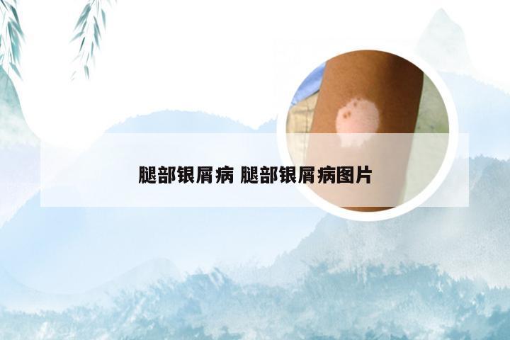 腿部银屑病 腿部银屑病图片