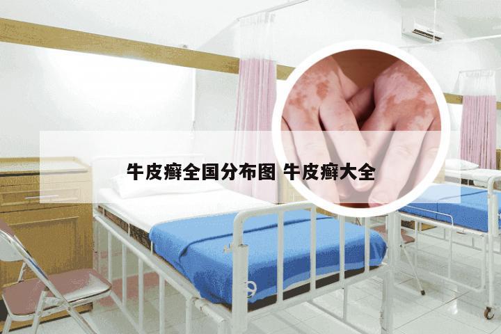 牛皮癣全国分布图 牛皮癣大全