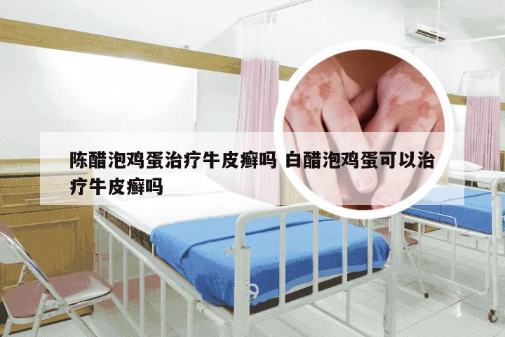 陈醋泡鸡蛋治疗牛皮癣吗 白醋泡鸡蛋可以治疗牛皮癣吗