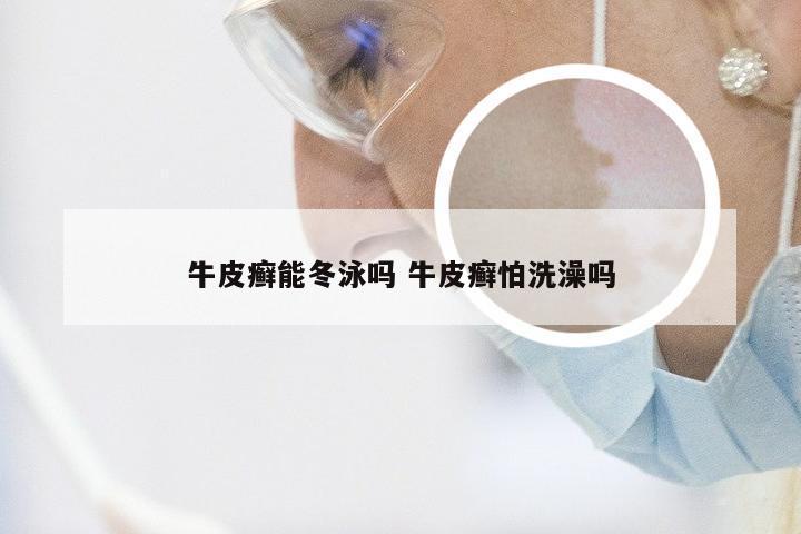 牛皮癣能冬泳吗 牛皮癣怕洗澡吗