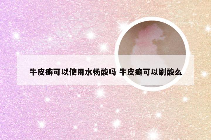 牛皮癣可以使用水杨酸吗 牛皮癣可以刷酸么