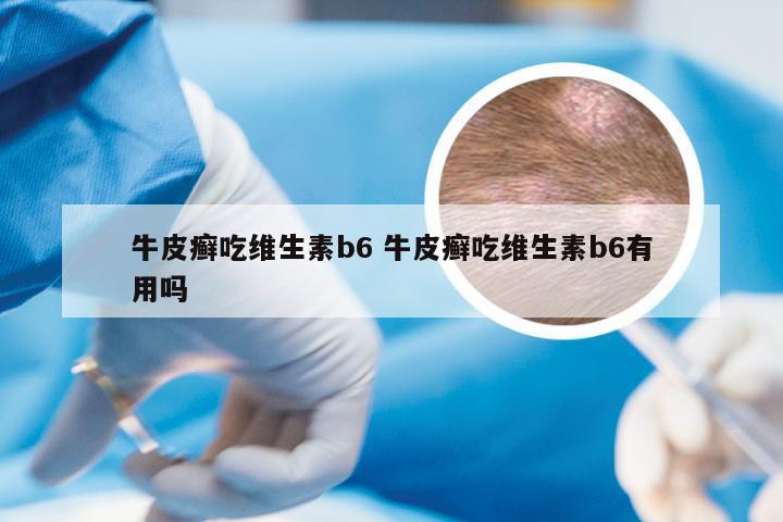 牛皮癣吃维生素b6 牛皮癣吃维生素b6有用吗