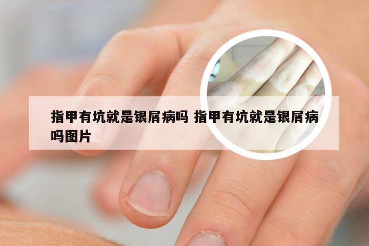 指甲有坑就是银屑病吗 指甲有坑就是银屑病吗图片
