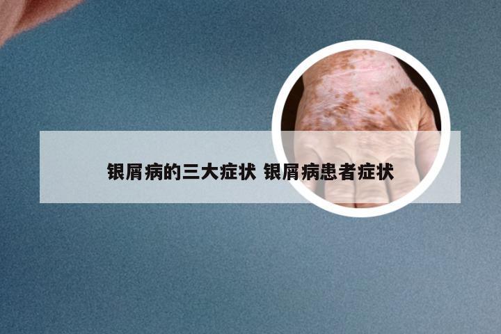 银屑病的三大症状 银屑病患者症状
