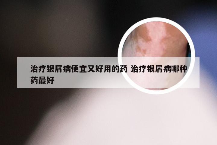 治疗银屑病便宜又好用的药 治疗银屑病哪种药最好