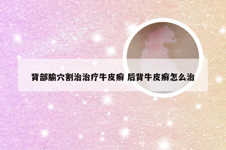 背部腧穴割治治疗牛皮癣 后背牛皮癣怎么治