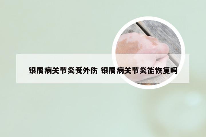 银屑病关节炎受外伤 银屑病关节炎能恢复吗