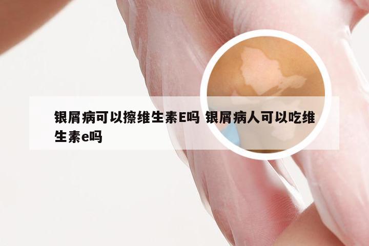 银屑病可以擦维生素E吗 银屑病人可以吃维生素e吗