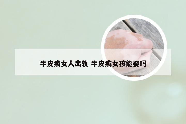 牛皮癣女人出轨 牛皮癣女孩能娶吗