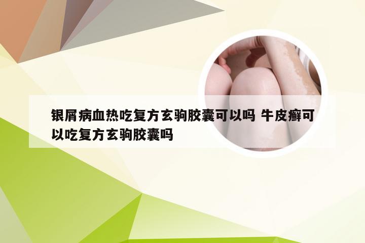 银屑病血热吃复方玄驹胶囊可以吗 牛皮癣可以吃复方玄驹胶囊吗