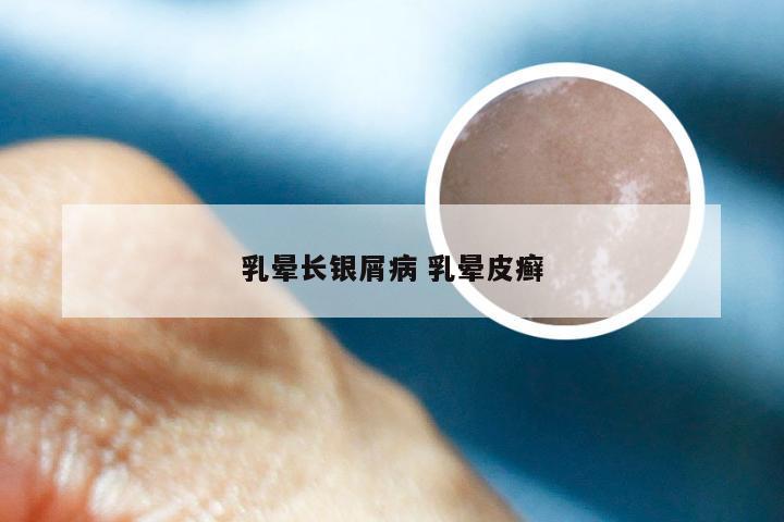 乳晕长银屑病 乳晕皮癣