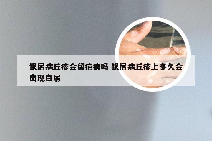 银屑病丘疹会留疤痕吗 银屑病丘疹上多久会出现白屑