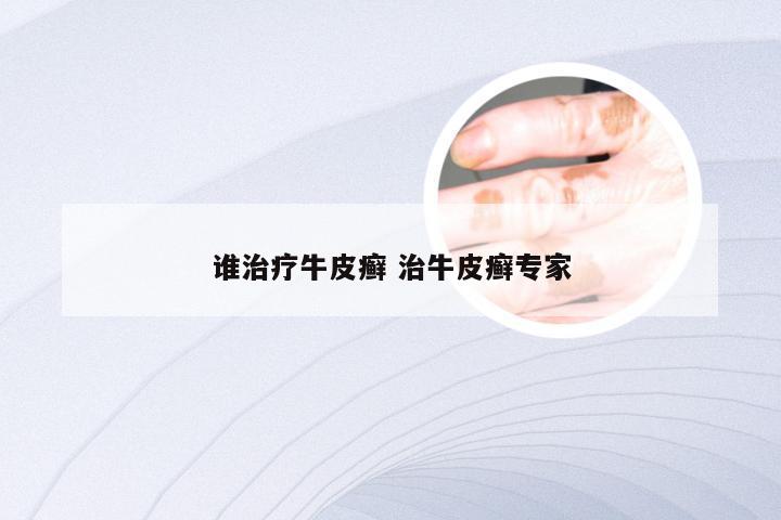 谁治疗牛皮癣 治牛皮癣专家