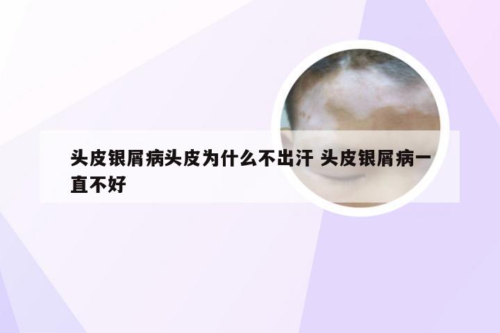 头皮银屑病头皮为什么不出汗 头皮银屑病一直不好
