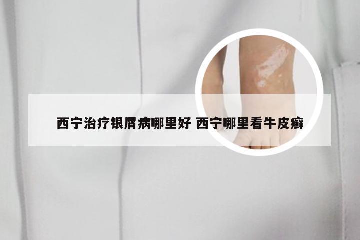 西宁治疗银屑病哪里好 西宁哪里看牛皮癣