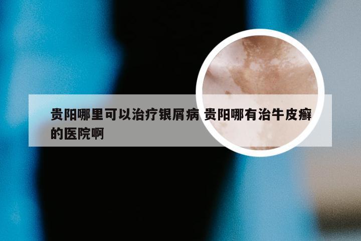 贵阳哪里可以治疗银屑病 贵阳哪有治牛皮癣的医院啊
