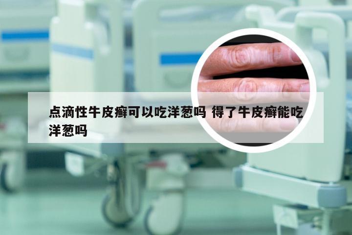 点滴性牛皮癣可以吃洋葱吗 得了牛皮癣能吃洋葱吗