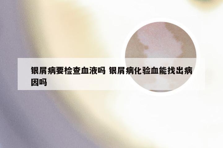 银屑病要检查血液吗 银屑病化验血能找出病因吗