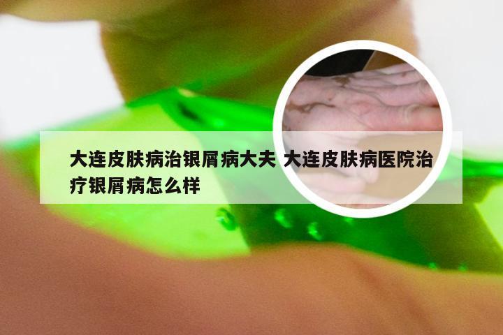大连皮肤病治银屑病大夫 大连皮肤病医院治疗银屑病怎么样