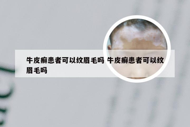 牛皮癣患者可以纹眉毛吗 牛皮癣患者可以纹眉毛吗