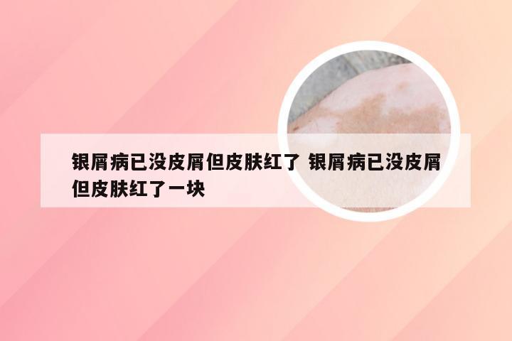 银屑病已没皮屑但皮肤红了 银屑病已没皮屑但皮肤红了一块