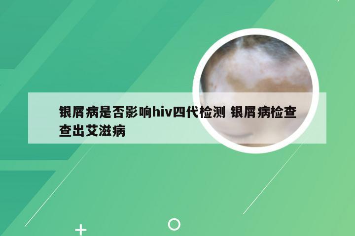 银屑病是否影响hiv四代检测 银屑病检查查出艾滋病