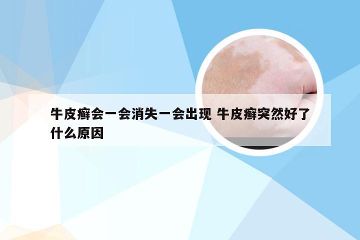 牛皮癣会一会消失一会出现 牛皮癣突然好了什么原因