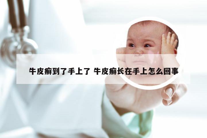 牛皮癣到了手上了 牛皮癣长在手上怎么回事