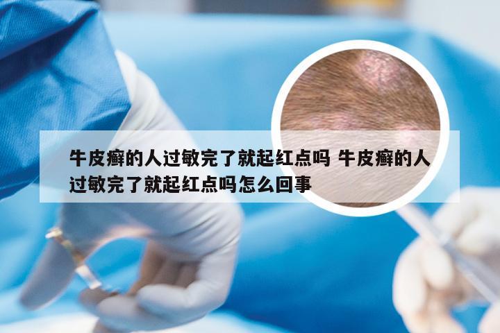 牛皮癣的人过敏完了就起红点吗 牛皮癣的人过敏完了就起红点吗怎么回事