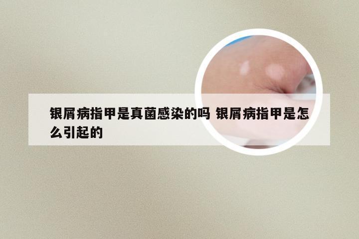银屑病指甲是真菌感染的吗 银屑病指甲是怎么引起的