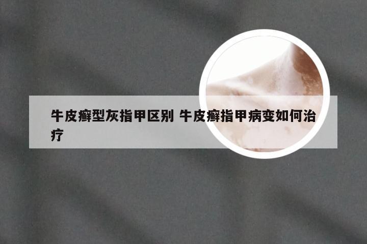 牛皮癣型灰指甲区别 牛皮癣指甲病变如何治疗