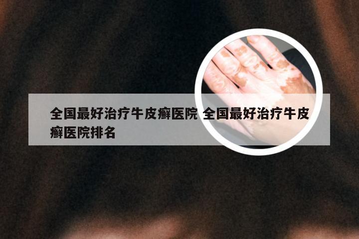 全国最好治疗牛皮癣医院 全国最好治疗牛皮癣医院排名