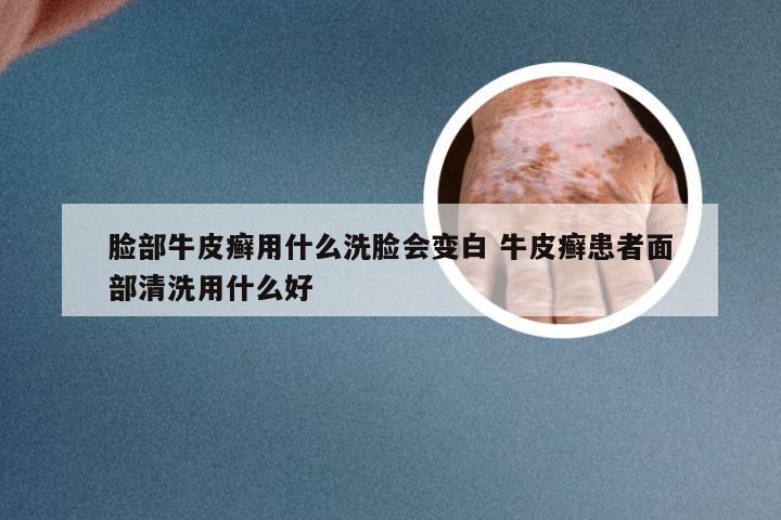 脸部牛皮癣用什么洗脸会变白 牛皮癣患者面部清洗用什么好