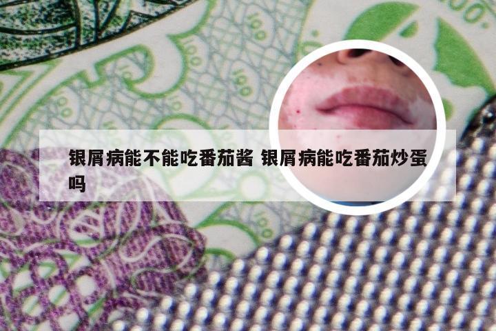 银屑病能不能吃番茄酱 银屑病能吃番茄炒蛋吗