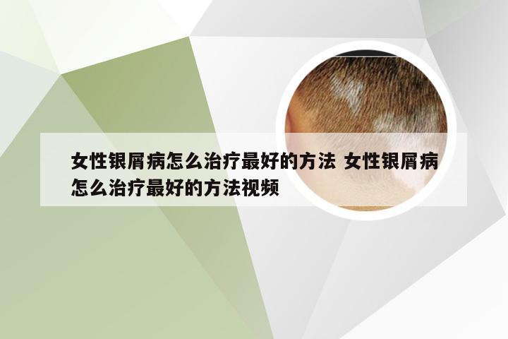 女性银屑病怎么治疗最好的方法 女性银屑病怎么治疗最好的方法视频