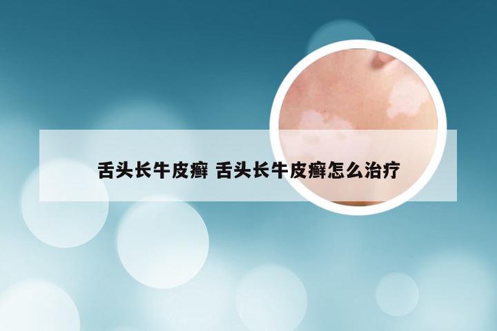 舌头长牛皮癣 舌头长牛皮癣怎么治疗